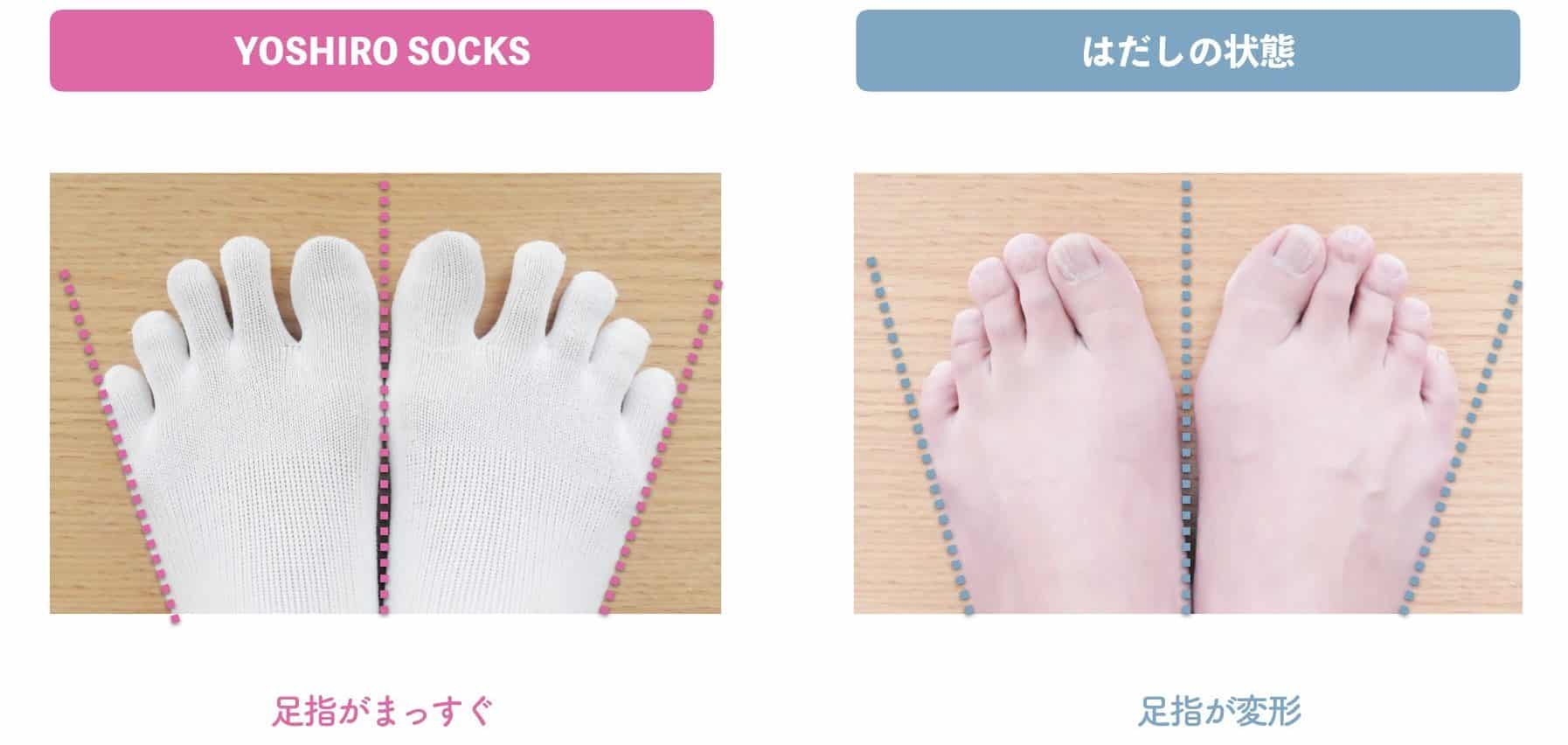 内反小趾の矯正は自力でできる？足の小指の激痛を根本から断つ全手順