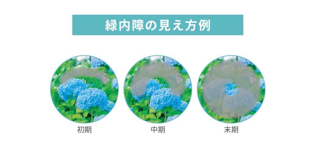 スマホで失明は本当か？暗闇操作が招く緑内障の真実と最新予防策