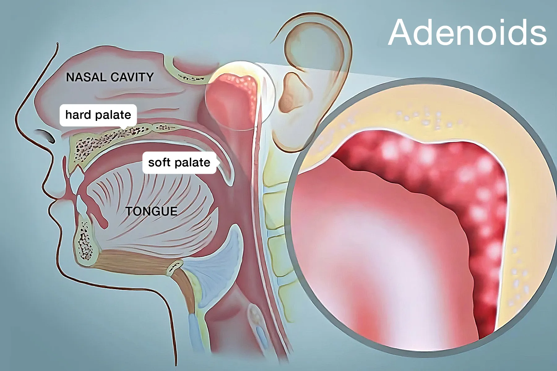 Inflamed Adenoids Adults