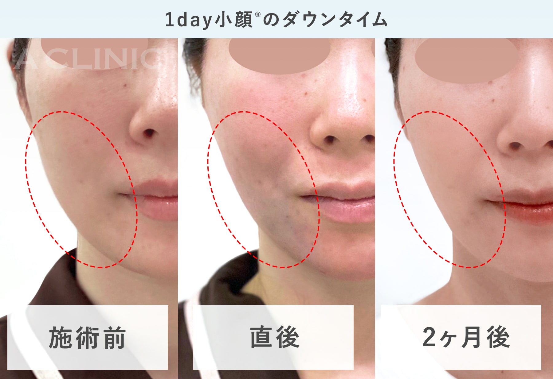 ダウンタイムとは？症状・期間目安と最新の回復法を徹底解説