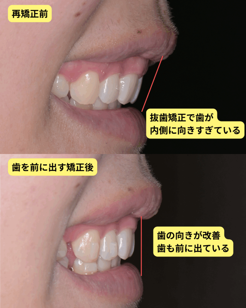 抜歯矯正で口元が引っ込みすぎ？老け顔化の真相と後悔を防ぐ修正法