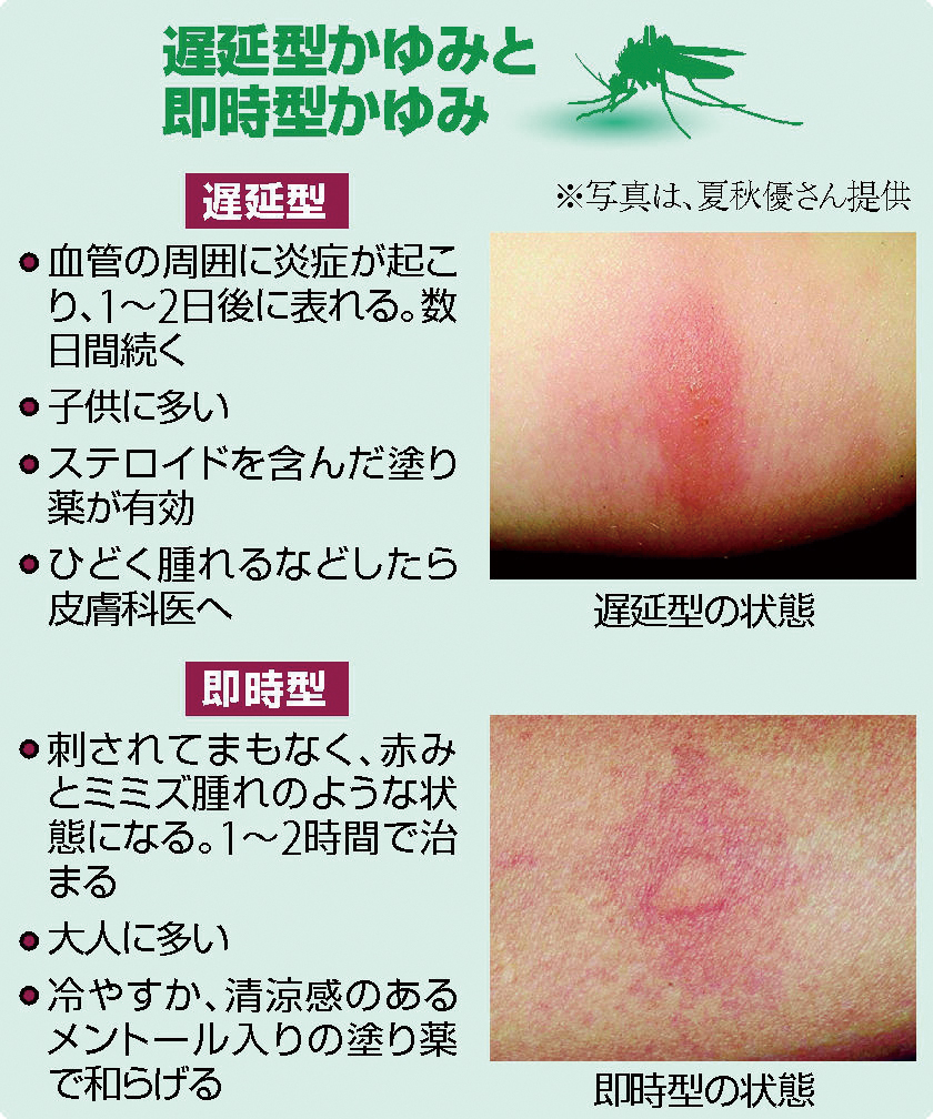蚊に刺されて異常に腫れる謎！水ぶくれや発熱を招くアレルギーの正体