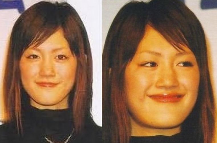 顎変形症を公表した芸能人の真相｜手術の劇的変化と保険適用の全貌