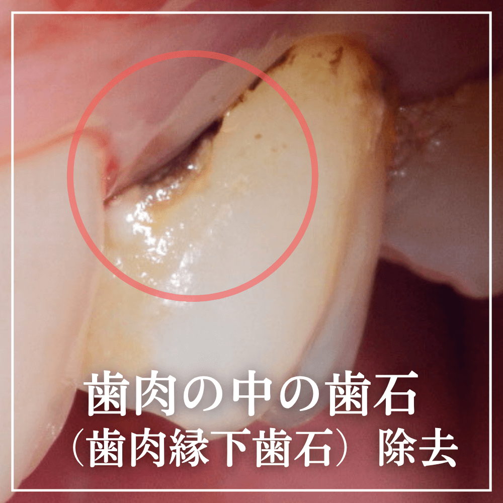 歯茎の奥に潜む黒い縁下歯石の正体！除去の痛みと費用・リスクを徹底解説