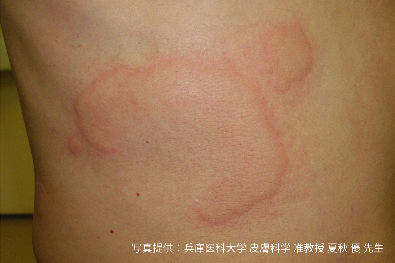 皮膚のかゆみと赤い腫れの正体は？ダニ刺され写真と見分け方完全解説