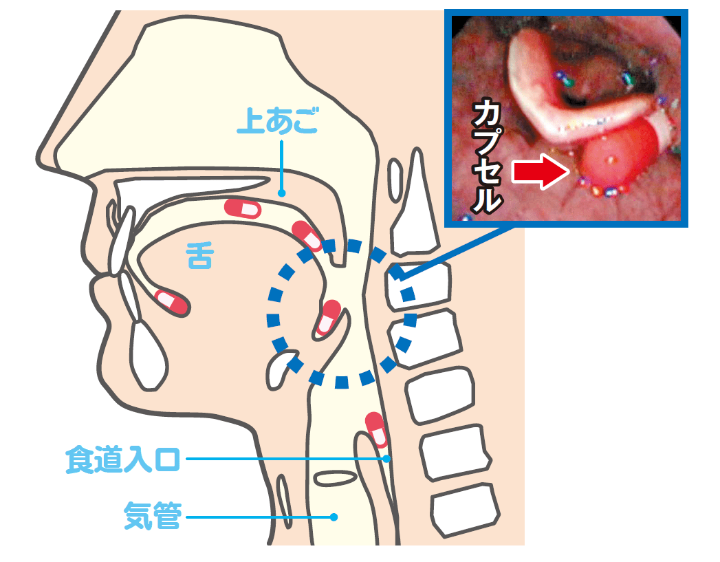 薬が喉に引っかかった！取れない時の安全な対処法と危険なNg行為