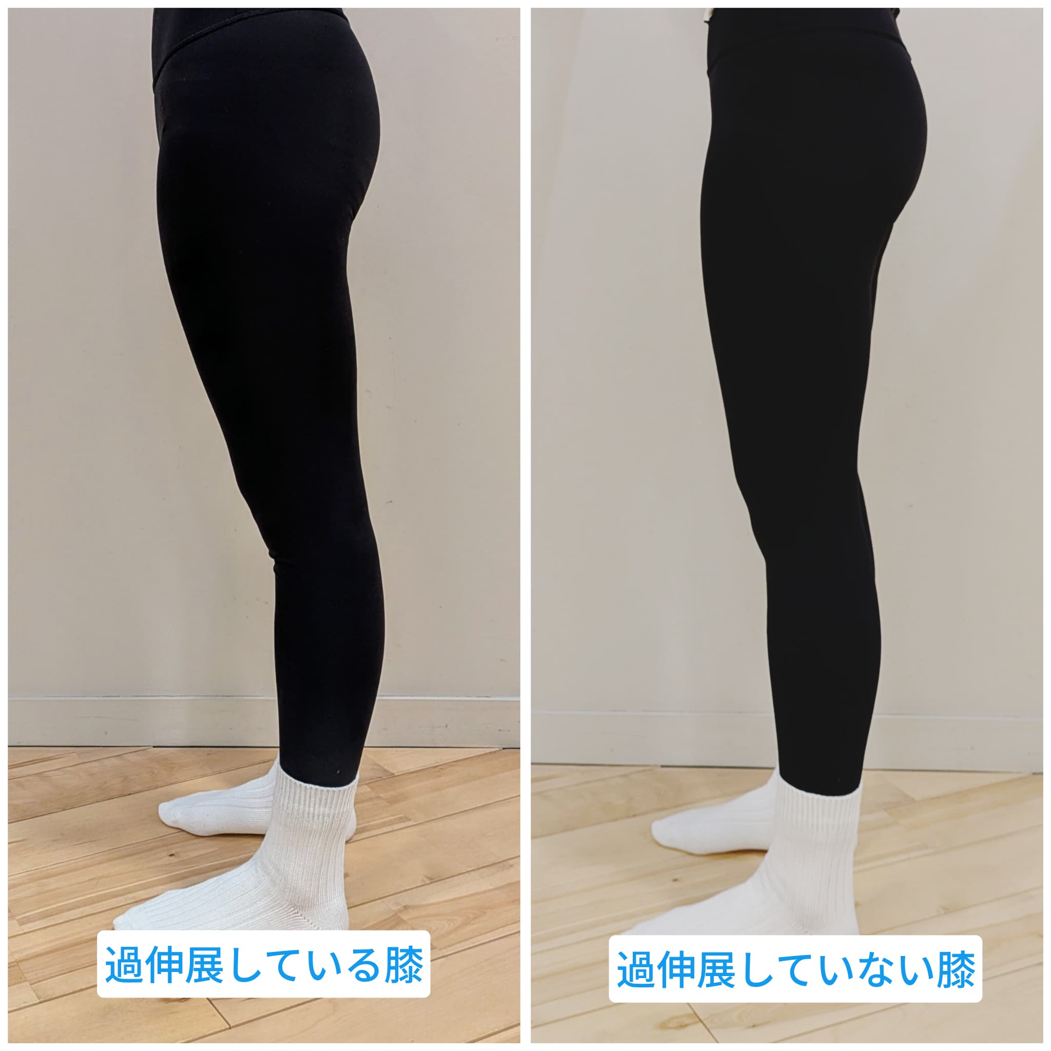 肘や膝が逆に曲がる過伸展とは？放置の危険とプロが教える改善法