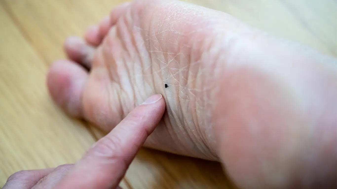 手のひらのほくろは癌？見分け方と危険なサインを皮膚科視点で徹底解説