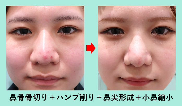 にんにく鼻に悩む男の劇的変化！自力ケアと整形の最適解ガイド