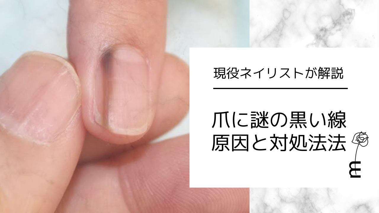 爪に現れた黒い線の正体は？写真で見るメラノーマと血豆の見分け方