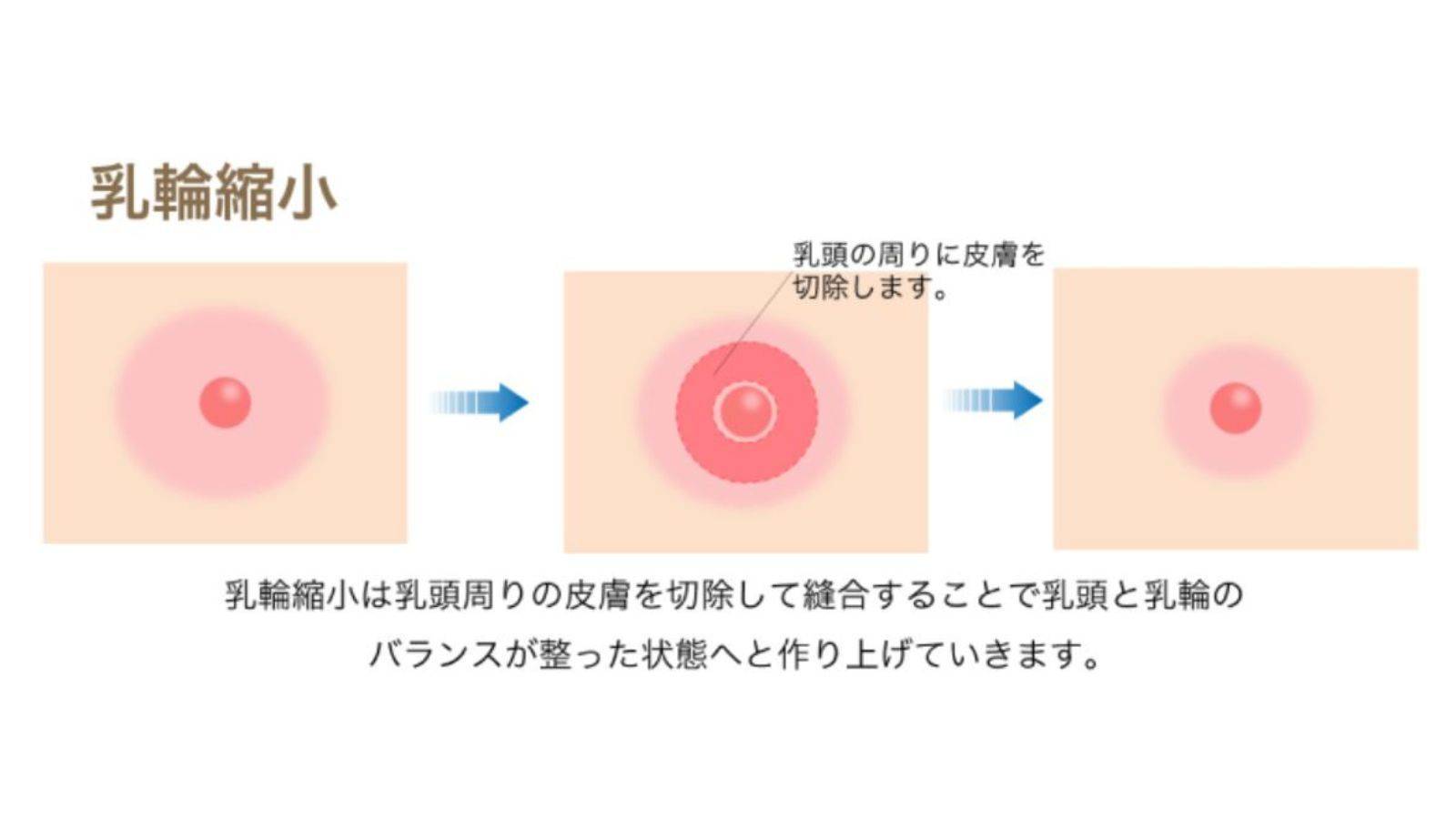 乳輪の大きさ平均は何Cm？肥大化の理由と縮小手術の費用相場【2026】