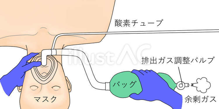 小児麻酔と緊急搬送の生命線、ジャクソンリース回路の本質と技術