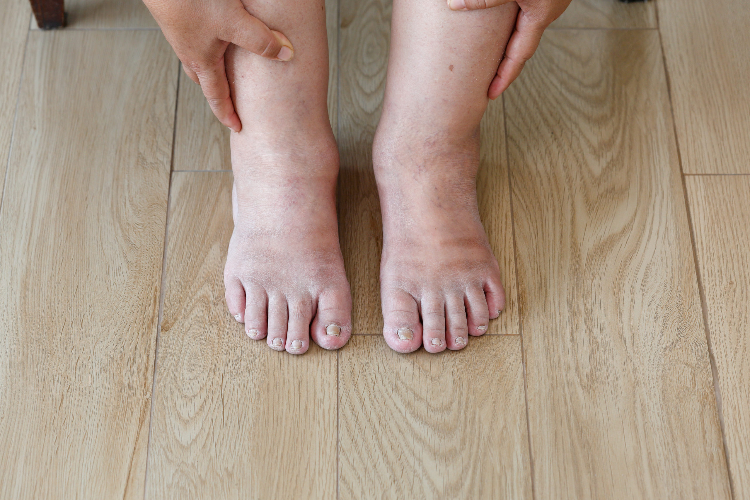 Swollen Feet and Ankles in Hot Weather