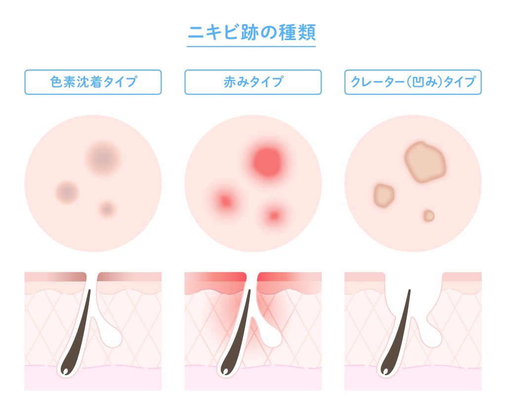 なぜニキビ跡は消えない？自力で治らない決定打と最新皮膚科治療の全貌