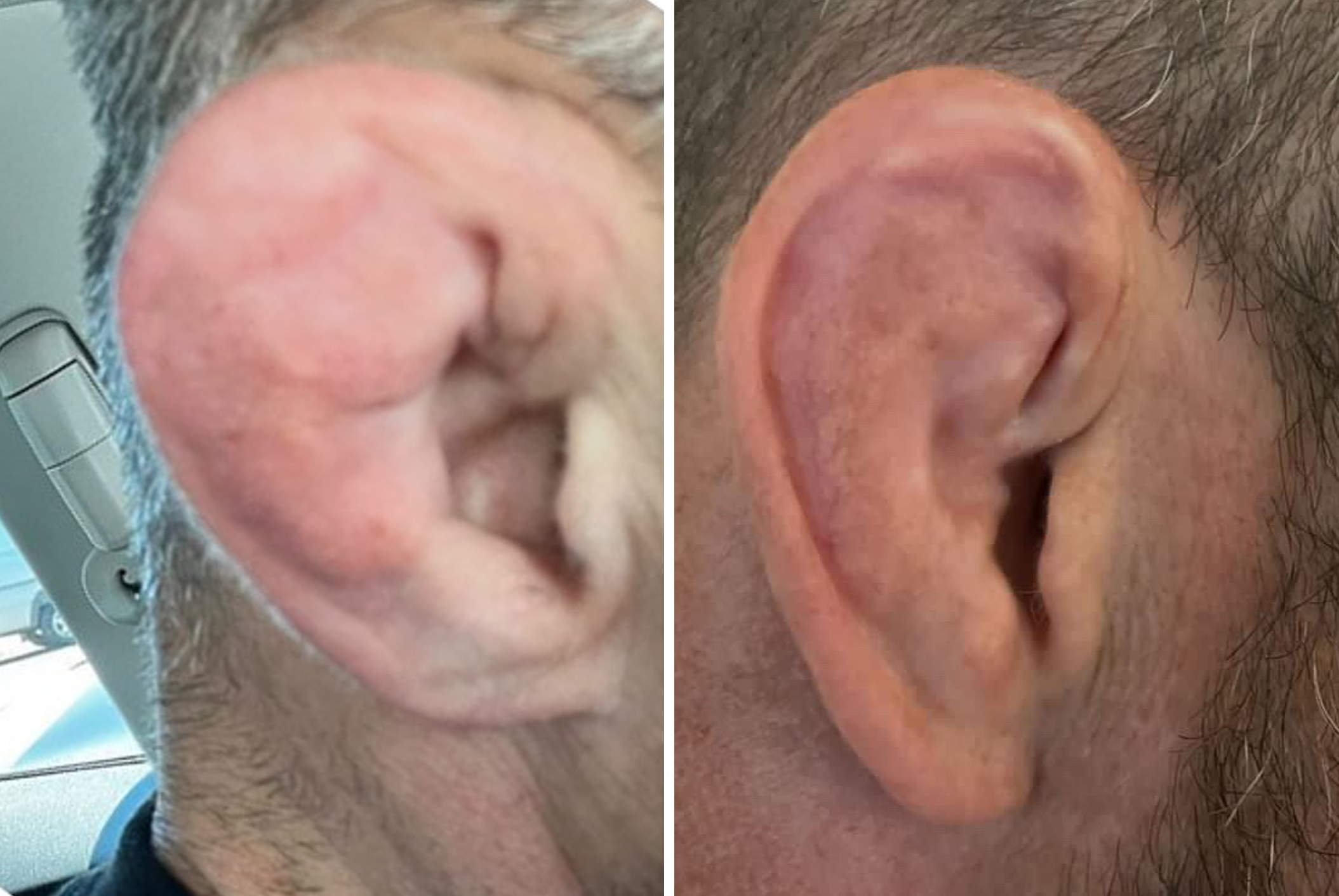 Does Cauliflower Ear Go Away