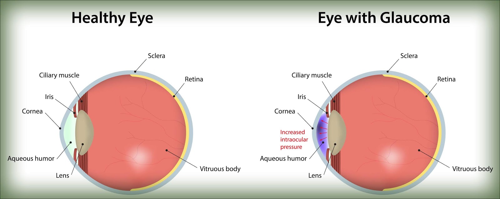 Family History Glaucoma Free Eye Test