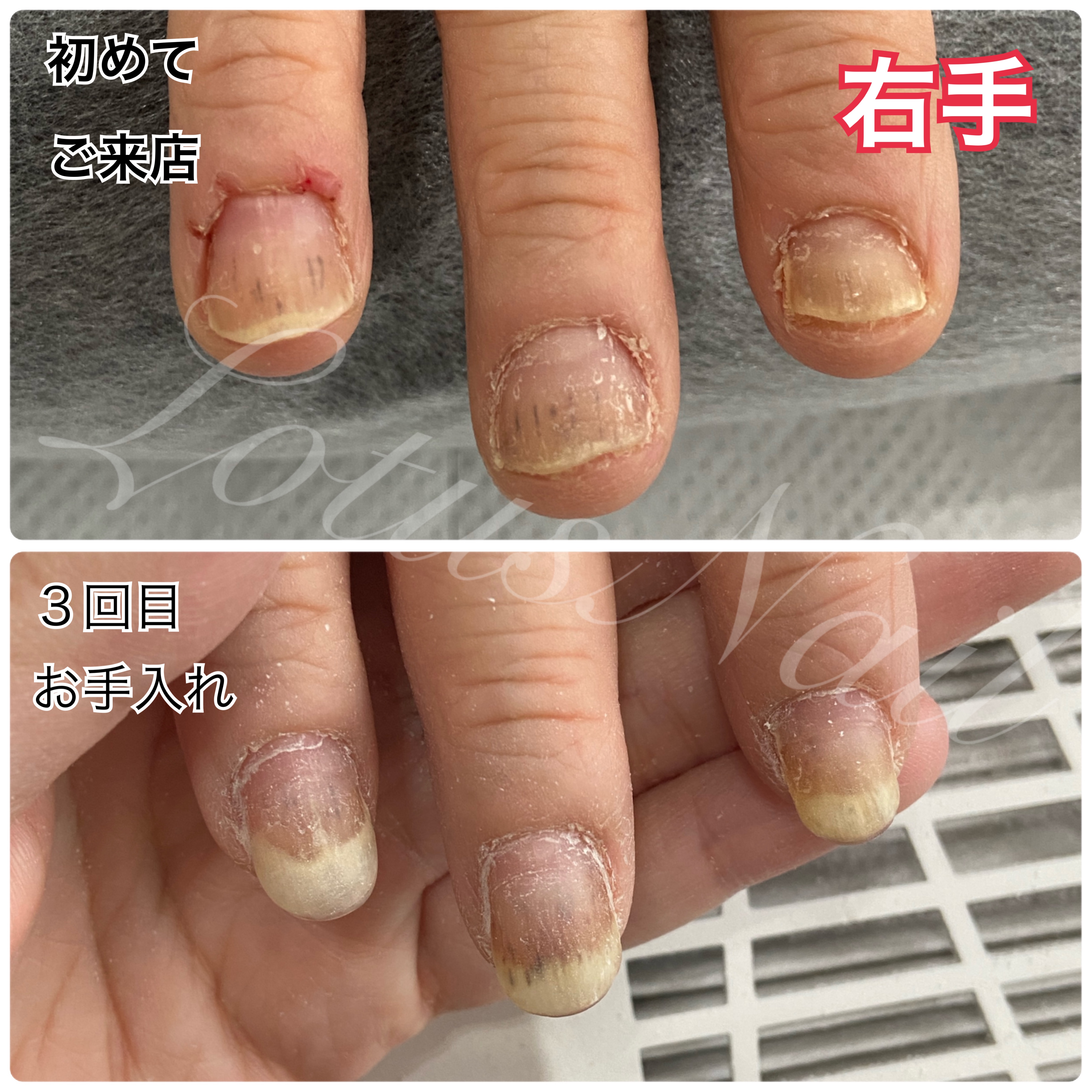 ジェルネイルの痒みと水泡は危険信号！突然発症するアレルギーの真相