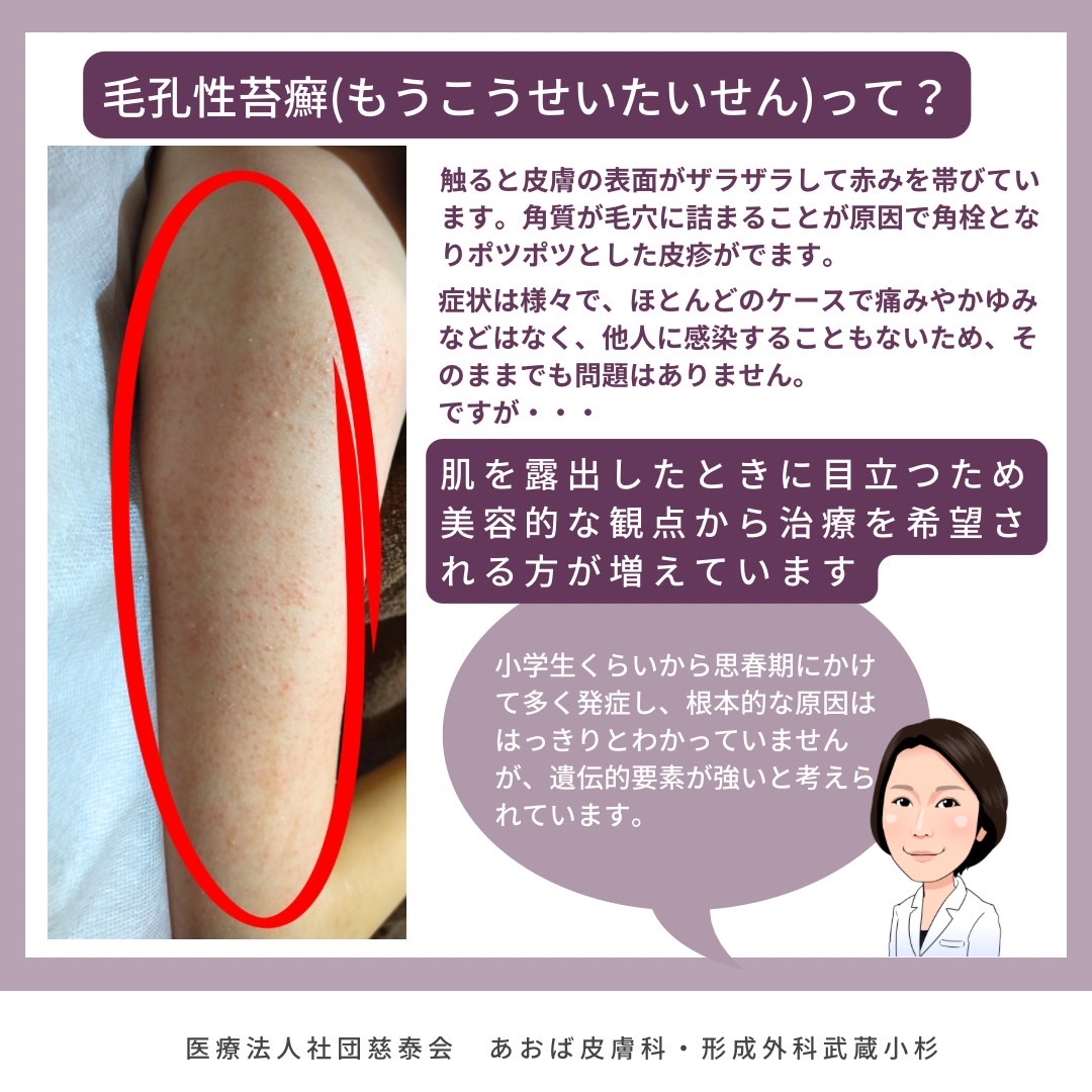二の腕ブツブツに市販薬は効く？毛孔性苔癬が治らない理由と治療の真実