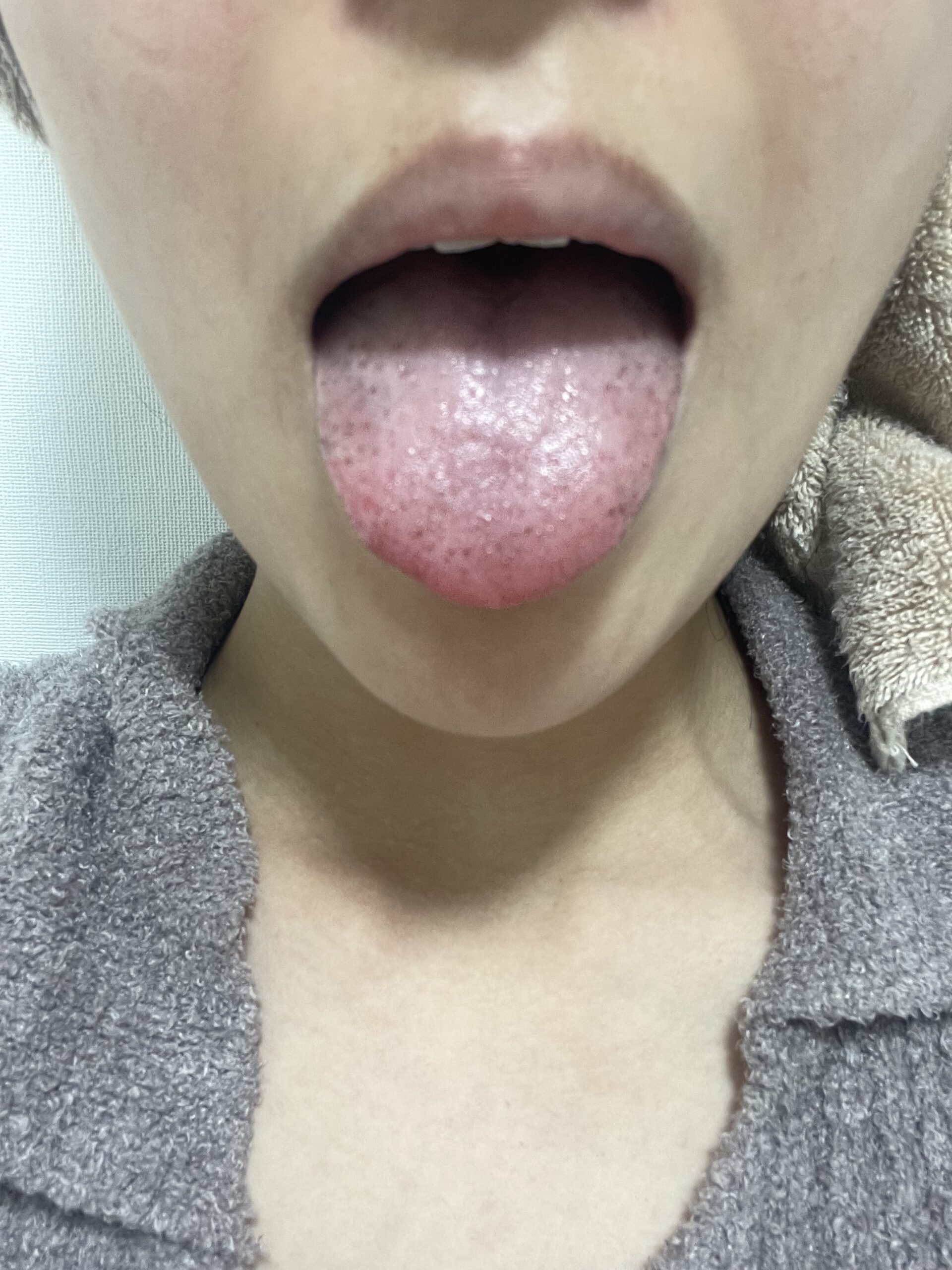舌の黒い点は病気？血豆やがんの見分け方と受診の目安