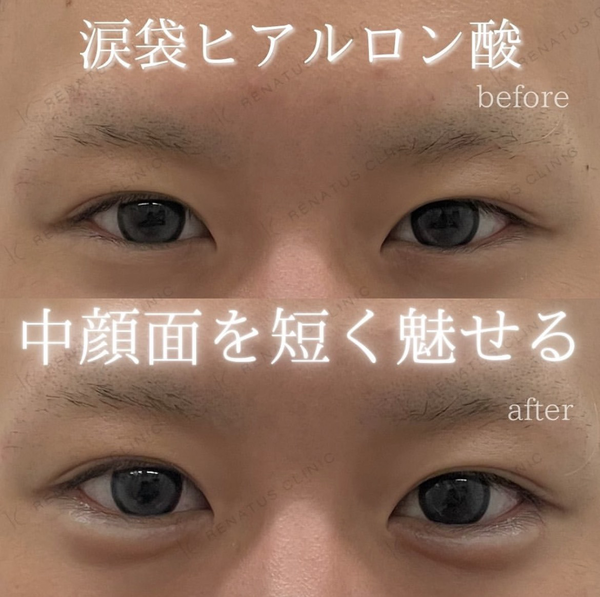 涙袋がある男は本当にモテる？女性100人の本音と自然な作り方を徹底解説