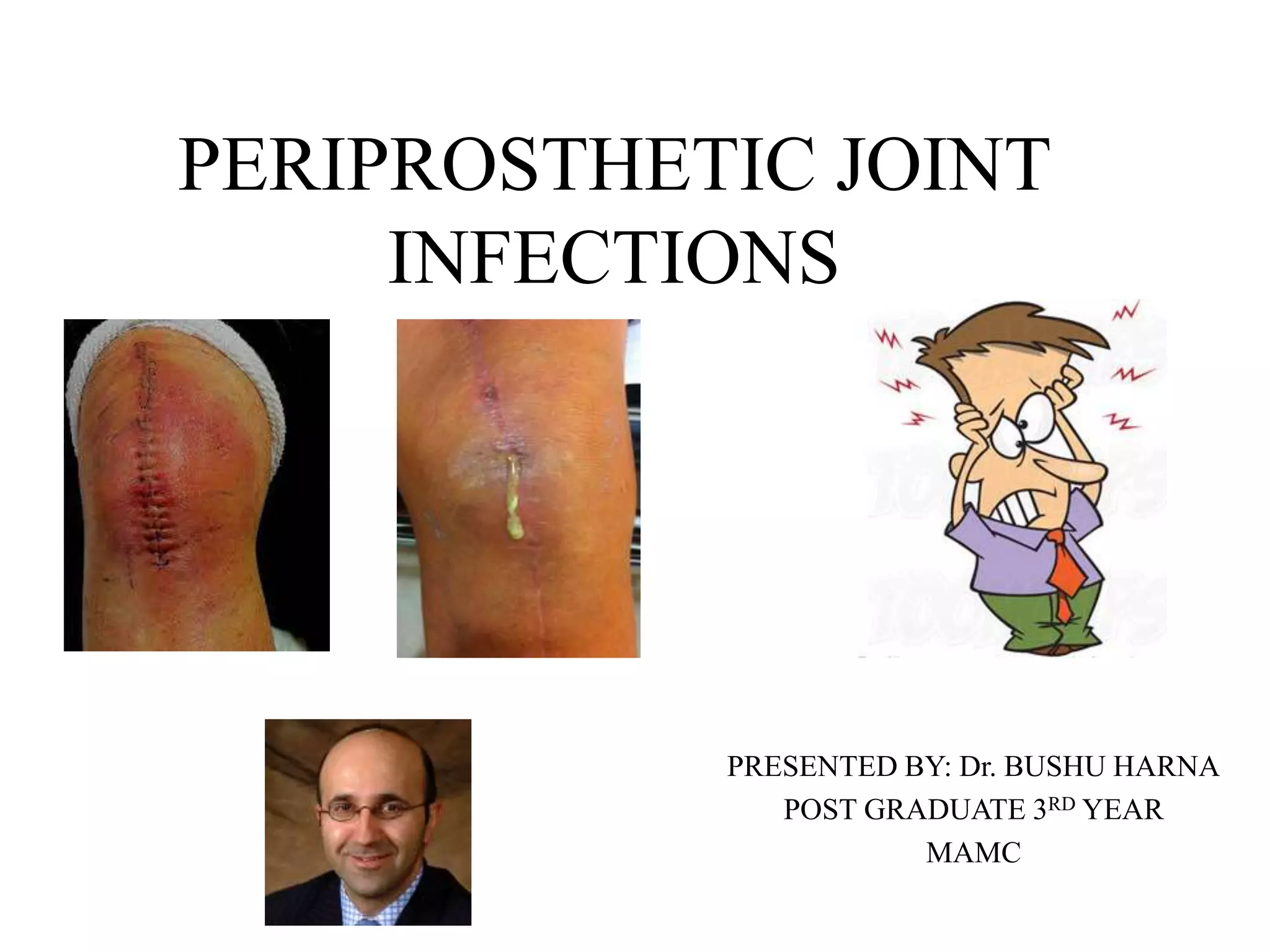 Periprosthetic Joint Infection Icd 10