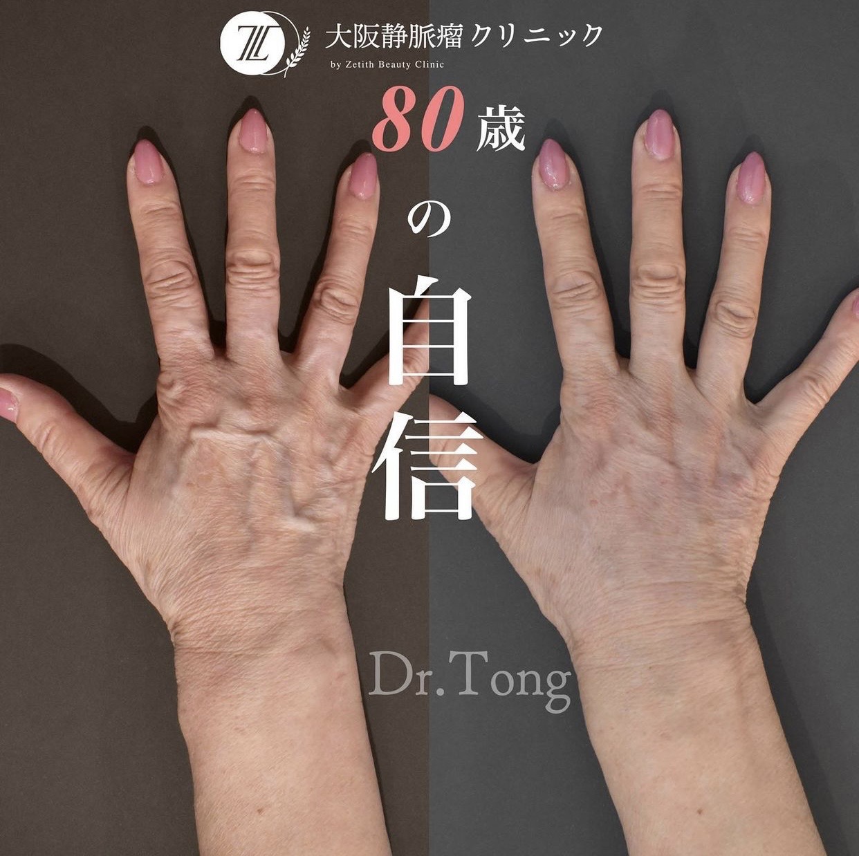 手の甲の血管が浮き出る原因は？病気と老化の違いと最新改善法