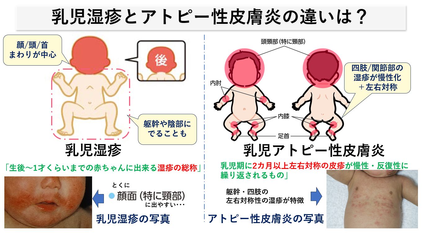 乳児湿疹とアトピーの違いとは？写真でわかる見分け方と受診の目安