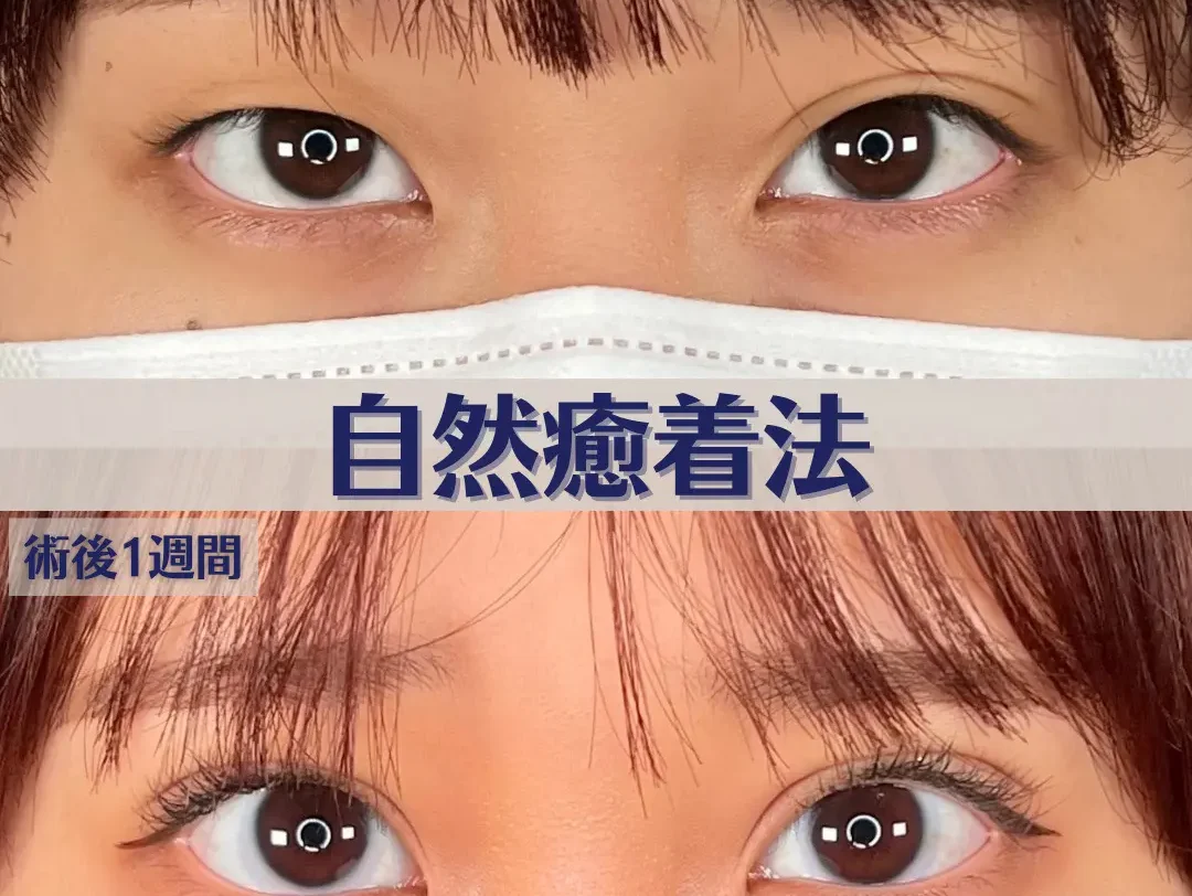 片目だけ二重になる原因とは？突然の左右差を治す方法と真相を徹底解明