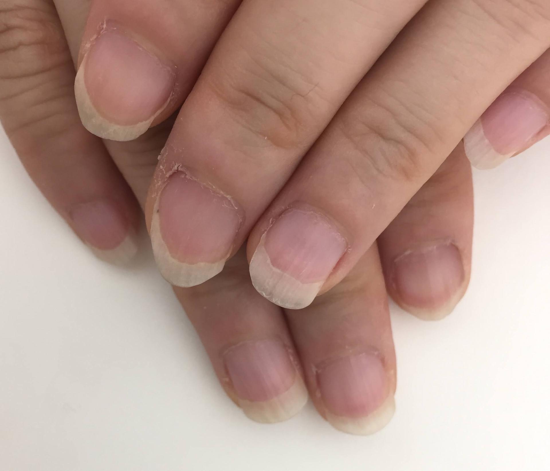 爪の白い部分が多い原因は病気か？爪甲剥離症の真相と自爪育成の極意