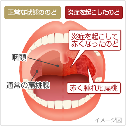 【最新】 朝起き たら 喉 が 痛い 話題のバズ動画・画像 #627
