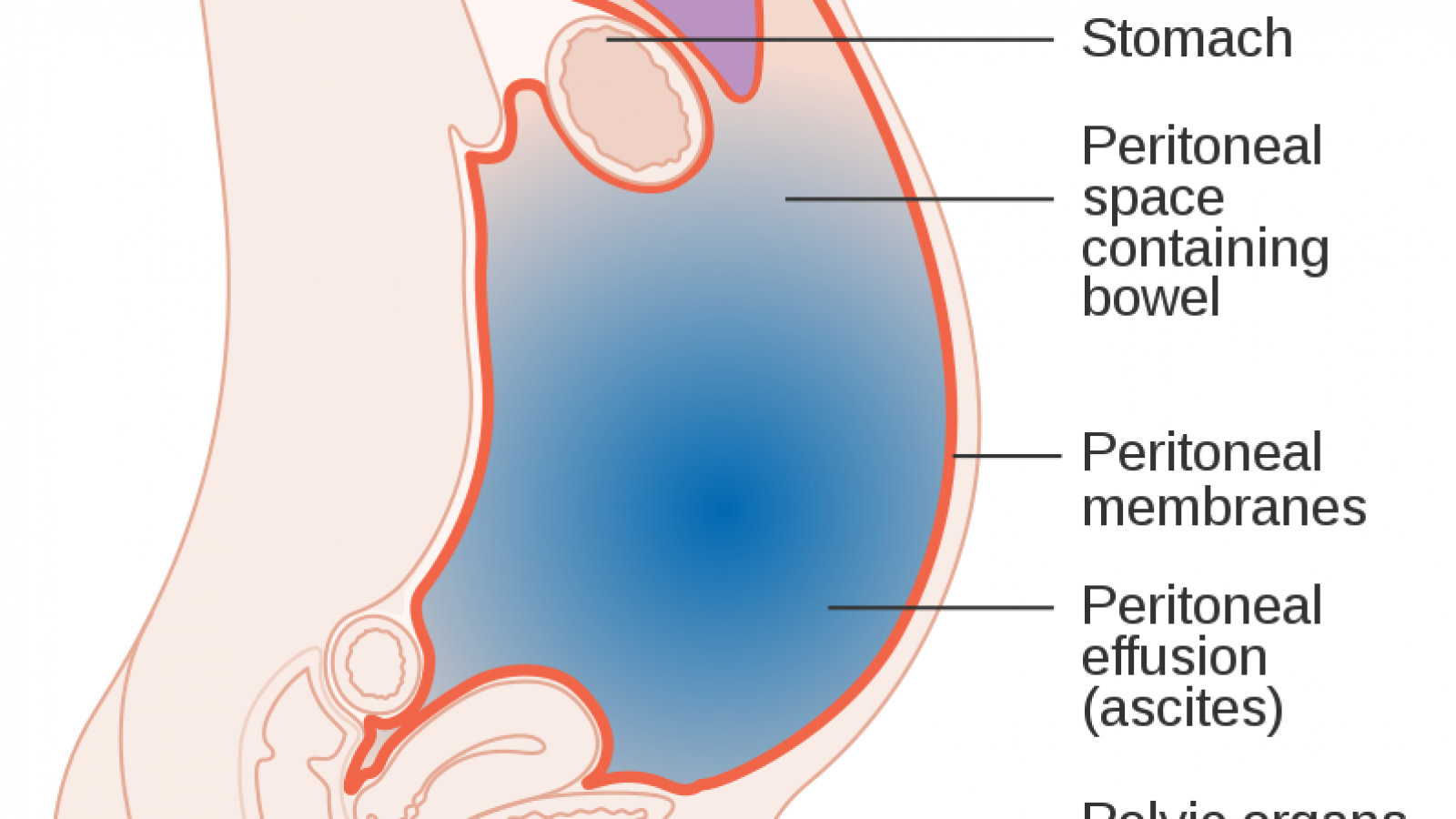 Fluid Building up in Stomach