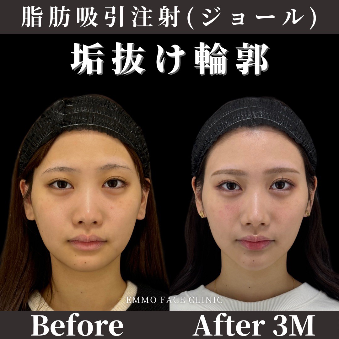 体重減でも顔が丸い理由とは？頬肉の落とし方と2026年最新小顔ケア