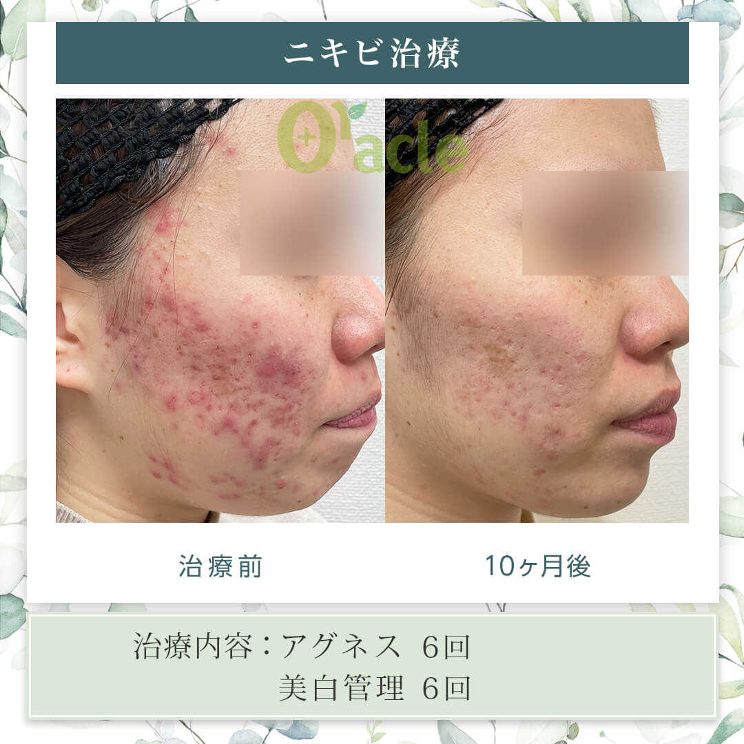 ニキビパッチの効果と悪化の真相！白・赤ニキビ別の正しい使い方