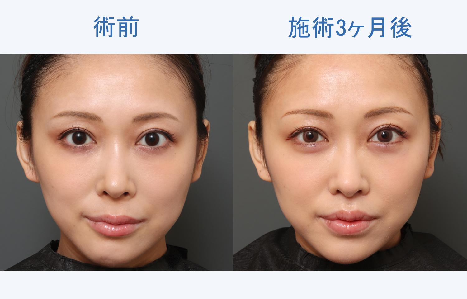 人中を短くする垢抜け全技術！整形なし裏技メイクから医療の真相まで徹底解剖
