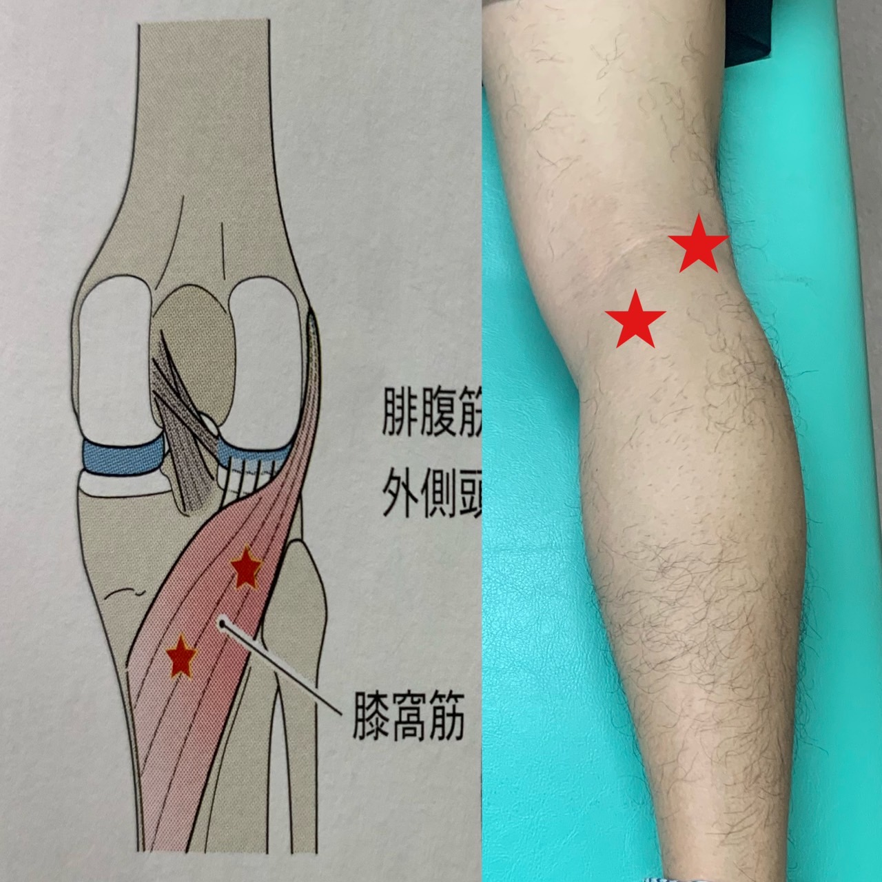 膝裏の筋が痛い原因は？伸ばすと痛む理由としこりの正体を徹底解説
