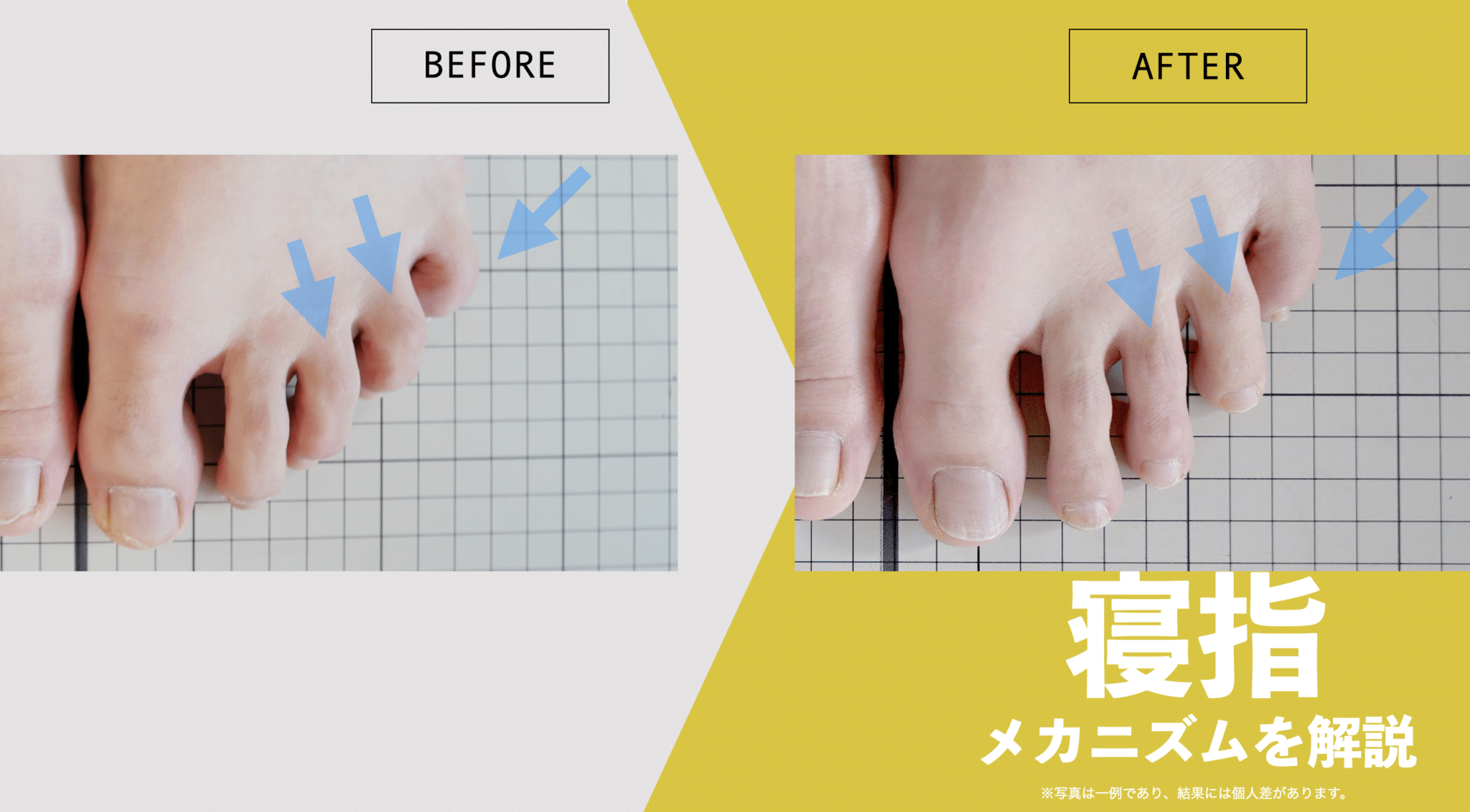 足の小指が倒れる「寝指」の治し方｜爪が外を向く原因と放置リスクを解説