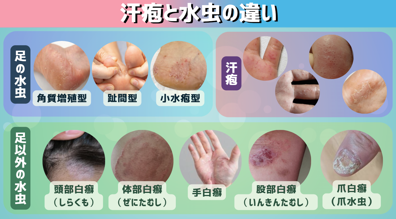 手足の水ぶくれは汗疱か水虫か？症状の違いと見分け方を徹底解説