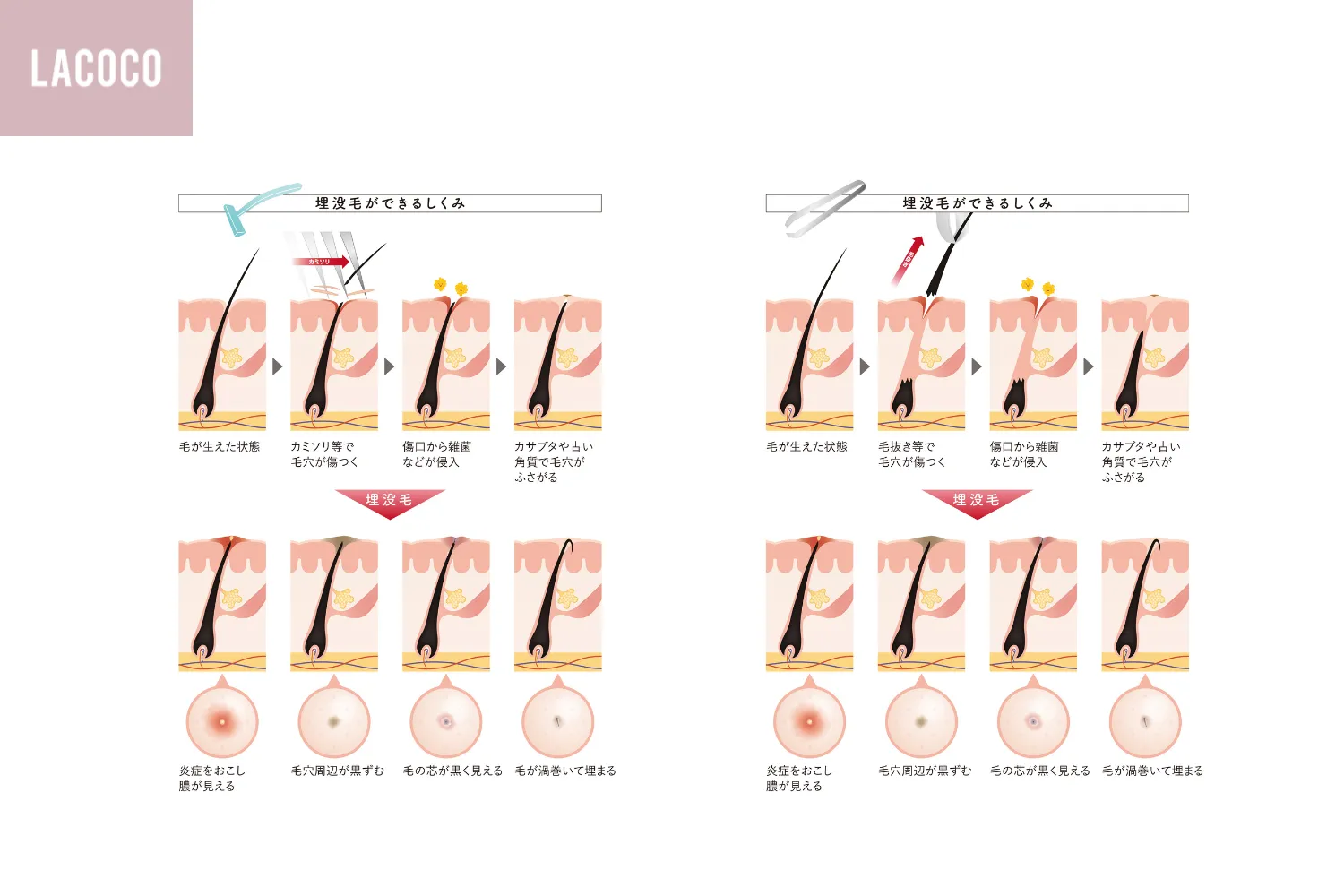 埋没毛と角栓の黒い塊の正体とは？皮膚科医が教える最新の正しい治し方