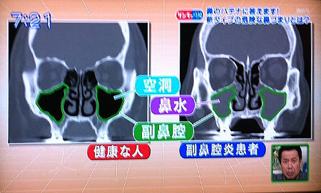 【プロフィール】 好 酸 球 性 副 鼻腔 炎 芸能人 最新ニュース速報 2026 #854