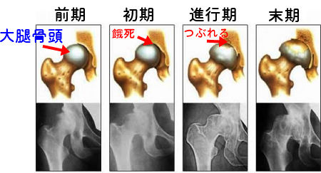 【徹底調査】 大腿 骨頭 壊死 芸能人 ファン必見の最新情報 #905