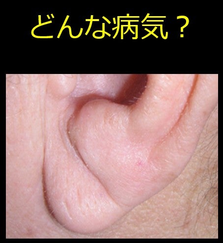 【最新】 耳たぶ の しわ 加 齢 最新写真集＆動画まとめ #787