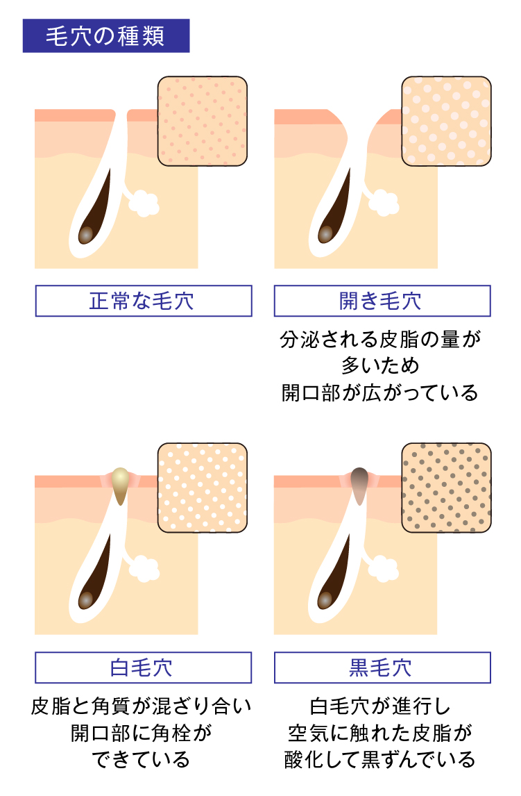 顔の毛穴が目立つ原因は日々のNg習慣？プロが明かす劇的改善策