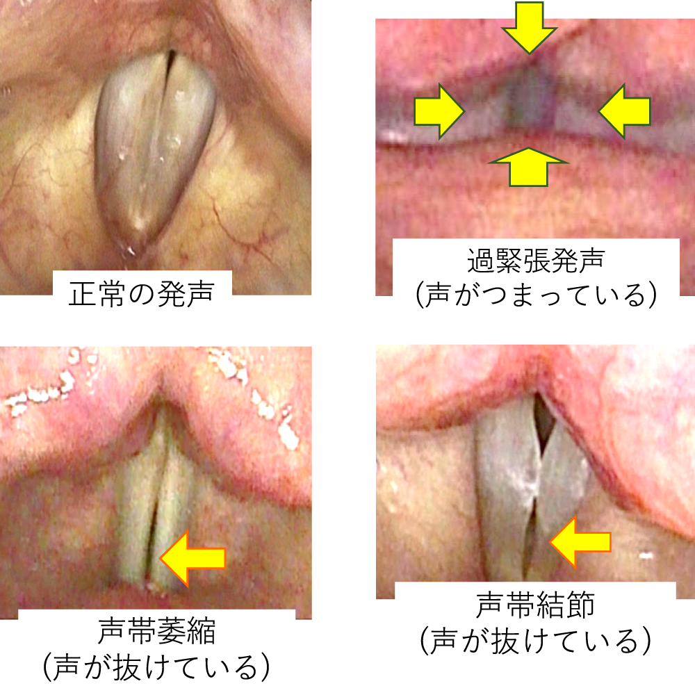 単なる声枯れに潜む影、偽膜性声帯炎の最新知見と初期症状を徹底解明