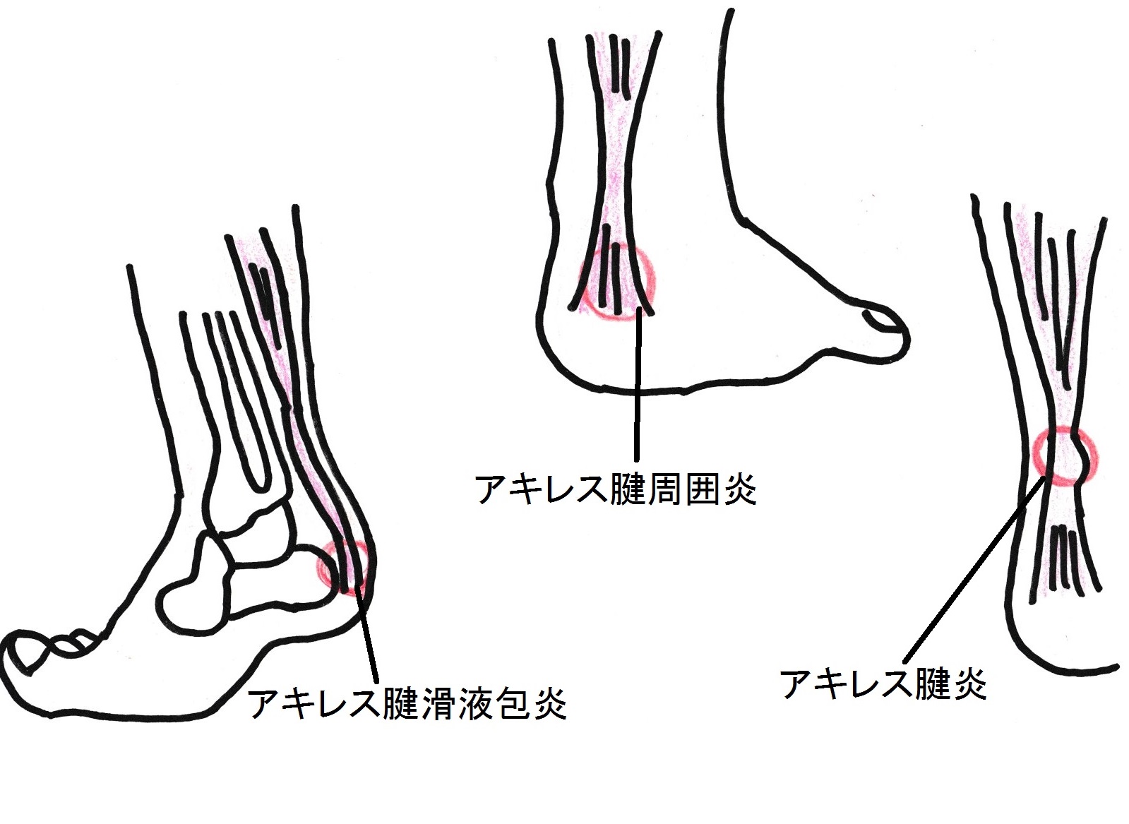 アキレス腱周囲炎で歩けない激痛の真相！治る期間とNg行動