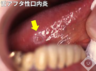【2026年最新】口内炎の激痛にサヨナラ！はちみつ治療の科学的根拠と正しい塗り方