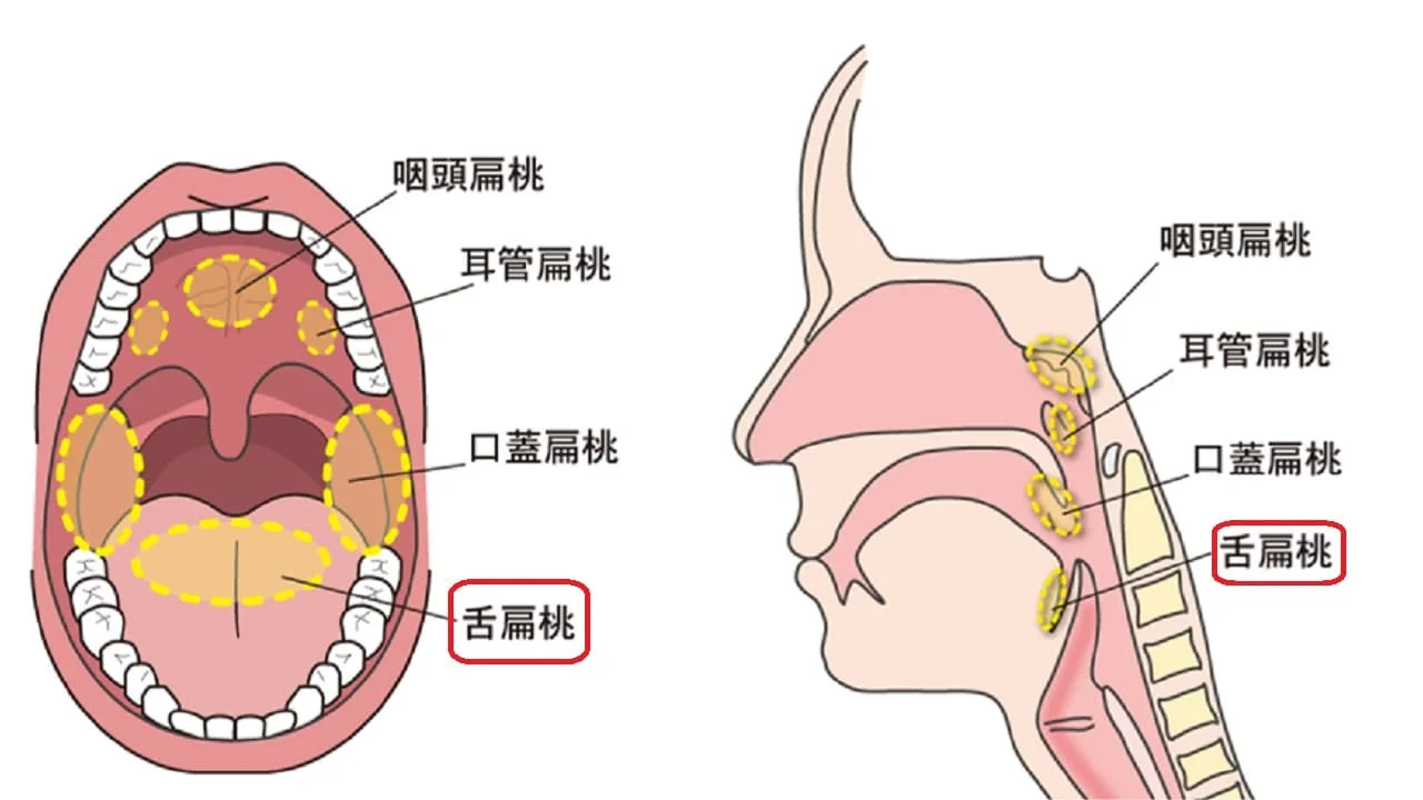 ベロの横の奥が痛い原因と見分け方｜危険な病気と病院の選び方
