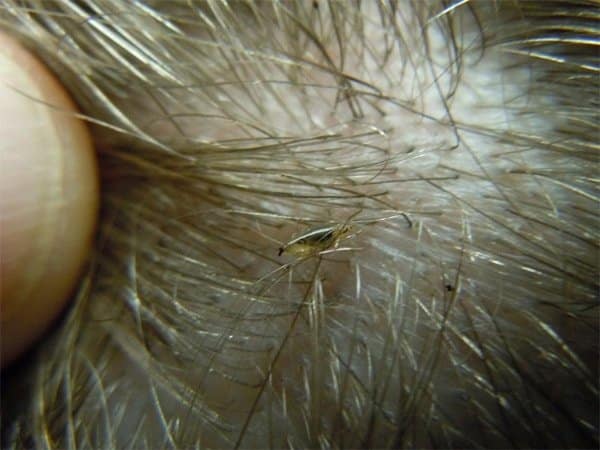 Early Stage Lice Blonde Hair